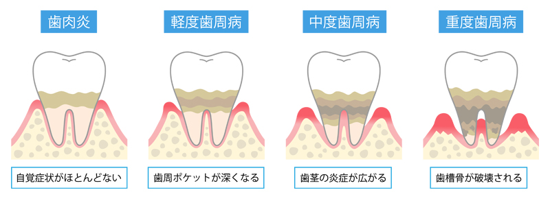 歯周病についての画像1