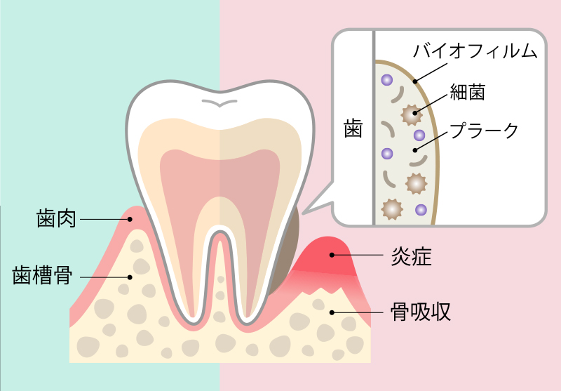 歯周病についての画像2